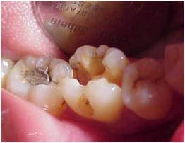 Gigi berlubang kecil, ke dokter gigi di bur menjadi besar 
